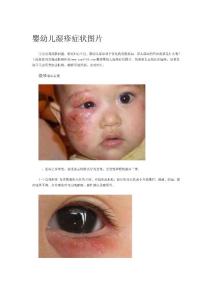 婴幼儿湿疹症状图片
