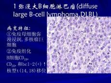 弥漫大B细胞淋巴瘤