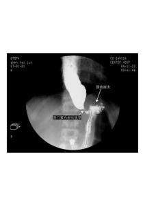 004贲门失弛缓症