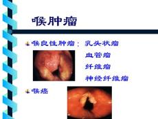 喉癌PPT课件
