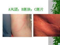 荨麻疹ppt课件