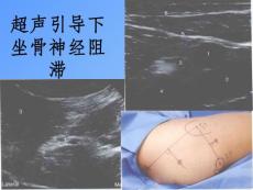 坐骨神经阻滞