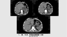脾破裂的ct诊断