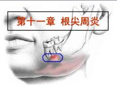 根尖周炎