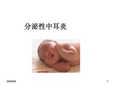 分泌性中耳炎