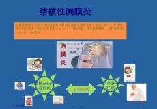 结核性胸膜炎