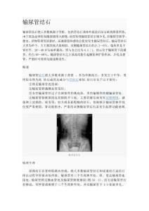输尿管结石