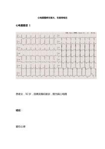 心电图图库 左室大、左室高电压
