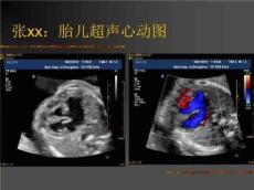 完全性肺静脉异位连接