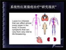 系统性红斑狼疮药