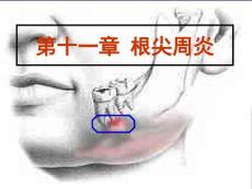 根尖周炎课件