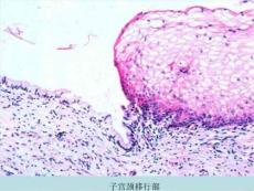 《宫颈炎宫颈癌》PPT课件