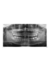 水平埋伏阻生智齒