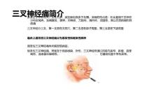 三叉神经痛常识