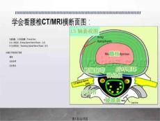 腰椎间盘突出影像