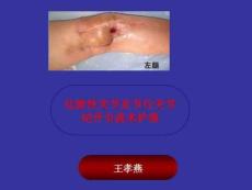 《化脓性关节炎》PPT课件