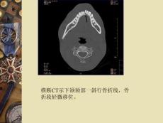 口腔影像学：第8章 颌骨骨折