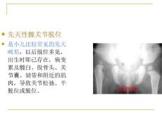 先天性髋关节脱位—中医骨病学