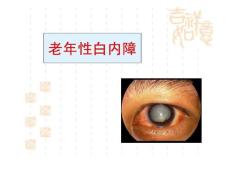 老年性白内障