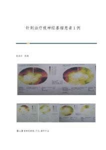 针刺治疗视神经萎缩患者1例