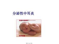 分泌性中耳炎