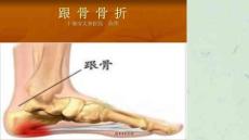 跟骨骨折护理课件