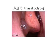 耳鼻喉医学—鼻息肉