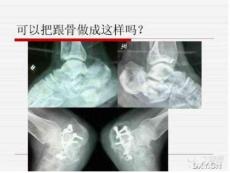 跟骨骨折手术技巧