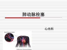 肺动脉栓塞12641