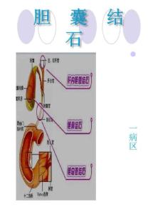 胆结石动画资料