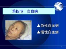 慢性淋巴细胞白血病