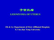 子宫肌瘤幻灯