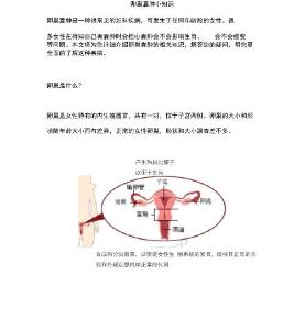卵巢囊肿小知识