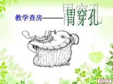 胃穿孔初稿