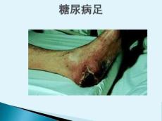 糖尿病足14154