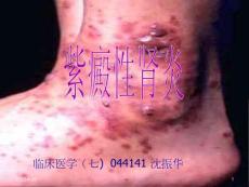 紫癜性肾炎