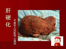 肝硬化完整