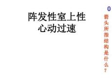 阵发性室性心动过速