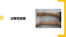 过敏性紫癜