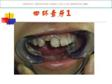 牙体病四环素牙课件
