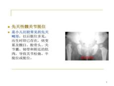 先天性髋关节脱位中医骨病学课件