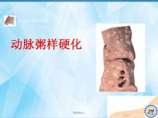 动脉粥样硬化课件
