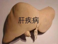 称为肝脓肿课件