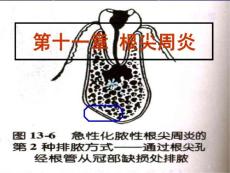 根尖周炎课件