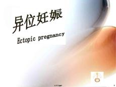 宫外孕最新课件