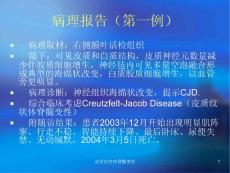 皮质纹状体脊髓变性-课件