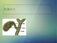 胆囊结石-课件