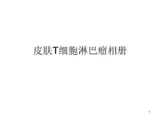 皮肤T细胞淋巴瘤课件