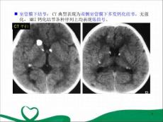 优质课件结节性硬化症.ppt