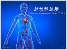 肺动静脉瘘课件